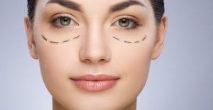 blepharoplastie