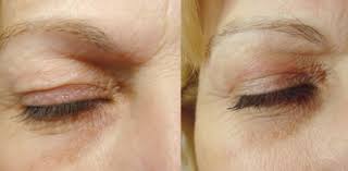 blepharoplastie laser Tunisie - avant apres