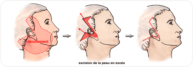 lifting facial en vidéo