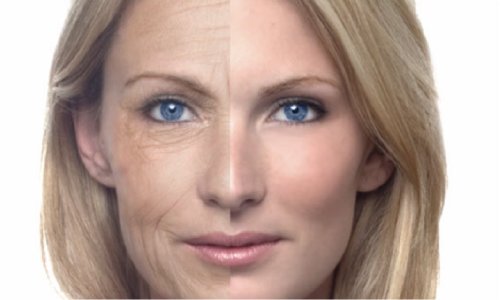 lifting du visage par laser