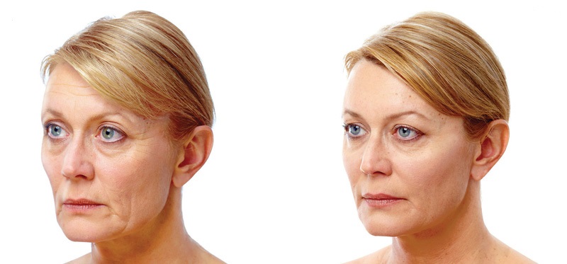 Lipofilling faciale Tunisie